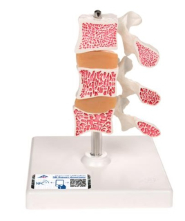 Model ľudských bedrových stavcov s osteoporózou 