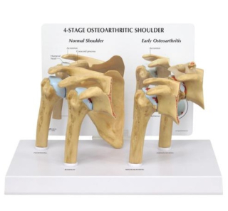 Model ramena, 4 stupne osteoartrózy