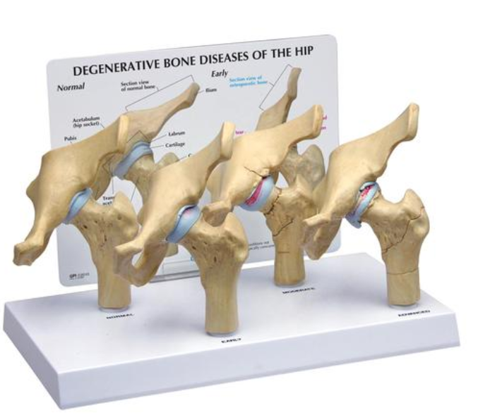 4-stupňové degeneratívne kostné choroby   modelu bedrového kĺbu