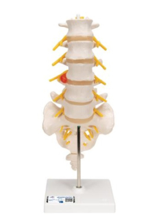 Model bedrovej chrbtice s dorzolaterálnou vyskočenou medzistavcovou platničkou