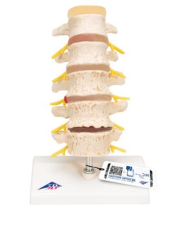 Model bedrovej chrbtice s degenerovanými stavcami a medzistavcovými platničkami