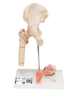 Model zlomeniny ľudskej stehennej kosti a osteoartrózy bedrového kĺbu